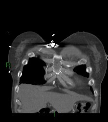 Aortic valve endocarditis (Radiopaedia 87209-103485 D 62).jpg