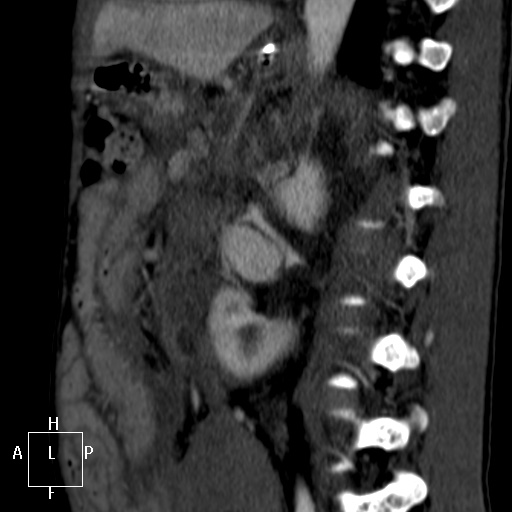 Aorto-left renal vein fistula (Radiopaedia 45534-49628 C 45).jpg