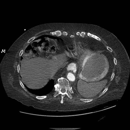 Aortoesophageal fistula with endovascular repair (Radiopaedia 73781-84592 Axial C+ CTPA 140).jpg
