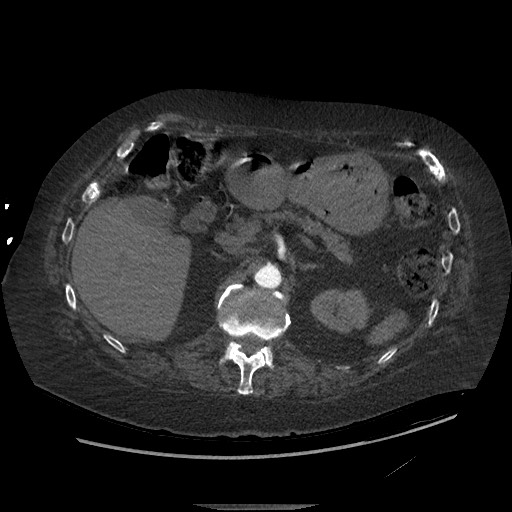 Aortoesophageal fistula with endovascular repair (Radiopaedia 73781-84592 Axial C+ CTPA 198).jpg