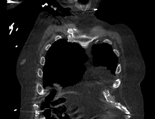 Aortoesophageal fistula with endovascular repair (Radiopaedia 73781-84592 Coronal C+ CTPA 11).jpg