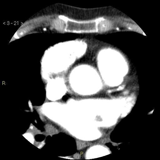 Aortoiliac occlusive disease (Radiopaedia 16828-16548 A 21).jpg