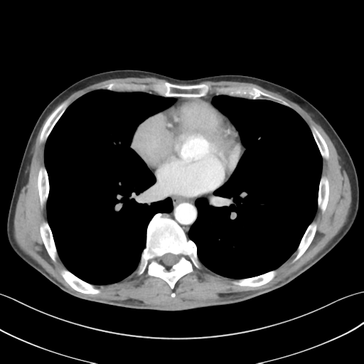Apical pleural calcification (Radiopaedia 46141-50499 Axial C+ delayed 41).png
