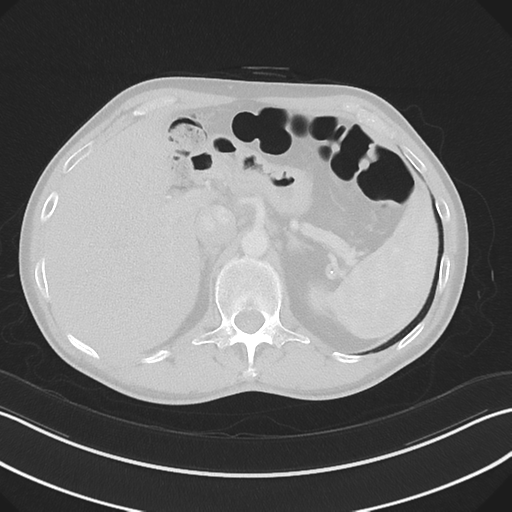 Apical pleural calcification (Radiopaedia 46141-50499 Axial lung window 71).png
