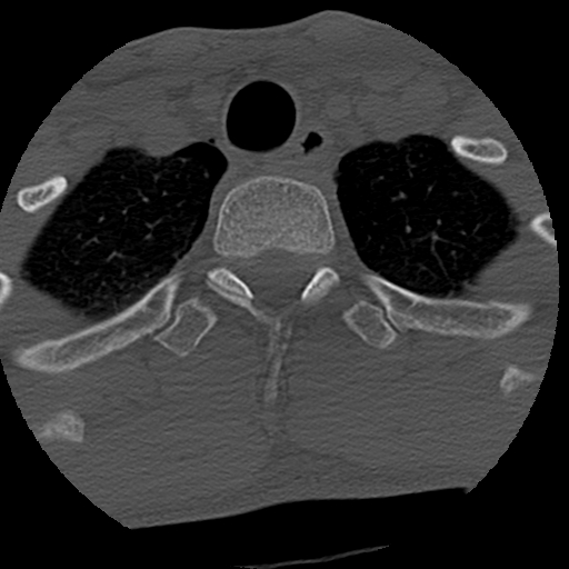Apical pneumothorax on cervical spine CT (Radiopaedia 45343-49368 Axial bone window 91).jpg