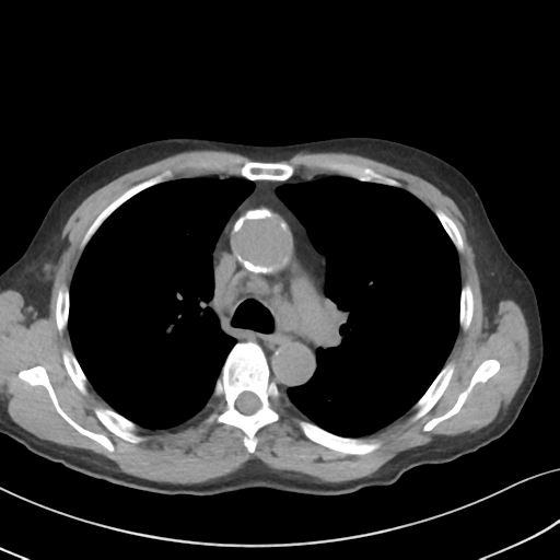 Apical pulmonary metastasis (Radiopaedia 46338-50754 B 26).png