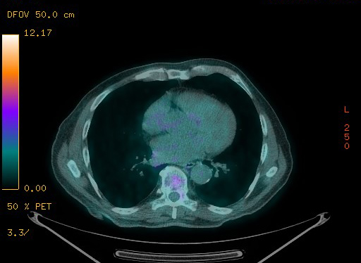 Appendiceal adenocarcinoma complicated by retroperitoneal abscess (Radiopaedia 58007-65041 Axial PET-CT 77).jpg