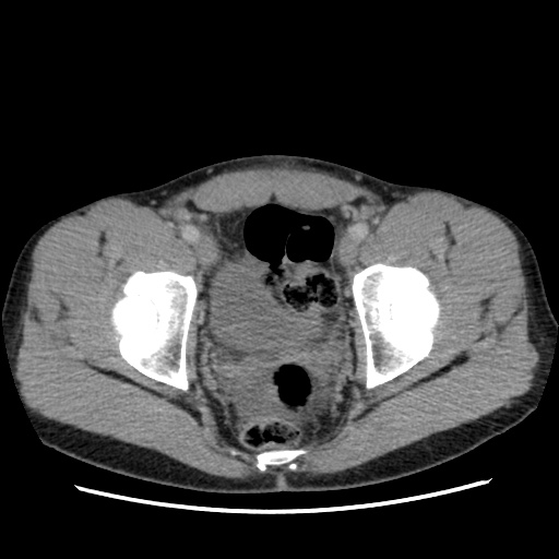 File:Appendicitis complicated by post-operative collection (Radiopaedia 35595-37114 A 79).jpg
