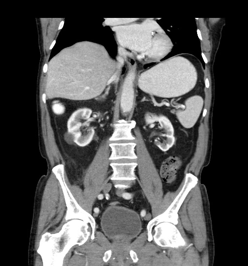 Appendicitis with localized perforation and abscess formation (Radiopaedia 49035-54130 B 28).jpg