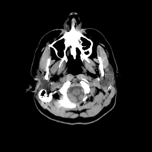 File:Arachnoid cyst - middle cranial fossa (Radiopaedia 88888).jpg