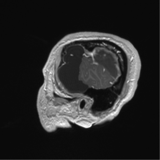 Arachnoid cyst with subdural hematoma (Radiopaedia 85892-101743 Sagittal T1 C+ 13).png