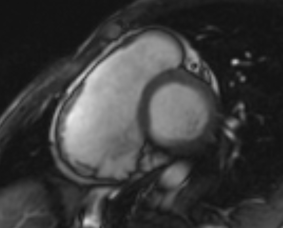 Arrhythmogenic right ventricular cardiomyopathy (Radiopaedia 69564-79464 short axis cine 203).jpg