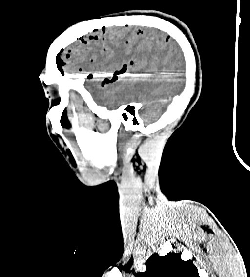 Arrow injury to the brain (Radiopaedia 72101-82607 H 48).jpg