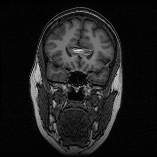 Arteriovenous malformation (cerebral) (Radiopaedia 40070-42580 Coronal T1 43).png
