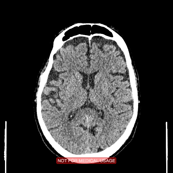 Artery of Percheron infarction (Radiopaedia 28679-28967 Axial non-contrast 66).jpg