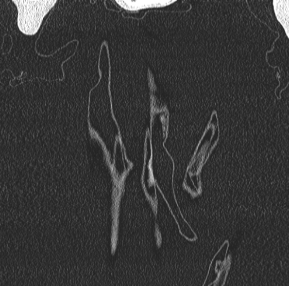 Aspergilloma- with Monod sign (Radiopaedia 44737-48532 Coronal lung window 65).jpg