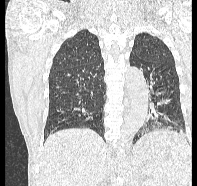 Aspergilloma (Radiopaedia 44592-48327 Coronal lung window 92).jpg