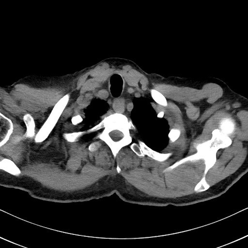 Aspergilloma on background pulmonary fibrosis (Radiopaedia 60942-68757 Axial non-contrast 6).jpg