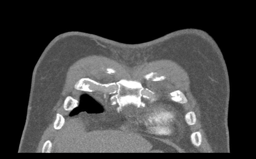 Aspirated tooth (Radiopaedia 28584-28844 Coronal C+ CTPA 9).jpg