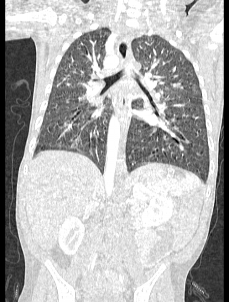 Asplenia syndrome (Radiopaedia 73083-83792 Coronal lung window 88).jpg