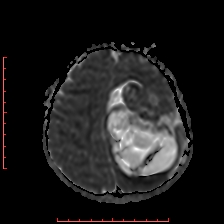 Astroblastoma (Radiopaedia 74287-85162 Axial ADC 50).jpg
