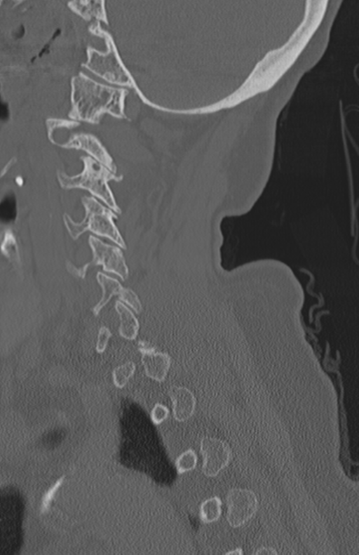 Atlanto-axial subluxation (Radiopaedia 36610-38176 Sagittal bone window 28).png
