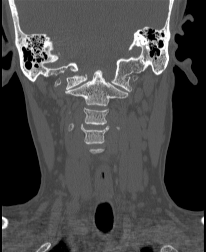 Atlanto-occipital assimilation with basilar invagination (Radiopaedia 70122-80188 Coronal bone window 80).jpg