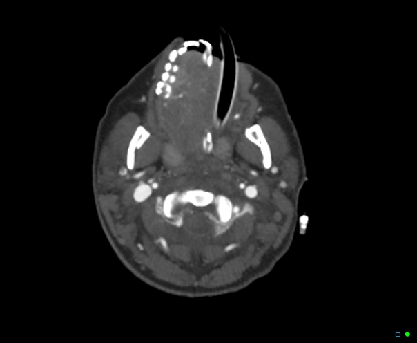 File:Atlanto-occipital dissociation - Traynelis type 1 (Radiopaedia 87570-103949 A 48).jpg