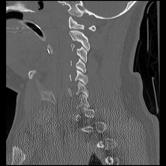 File:Atlanto-occipital dissociation injury (Radiopaedia 29274-29698 Sagittal bone window 21).png