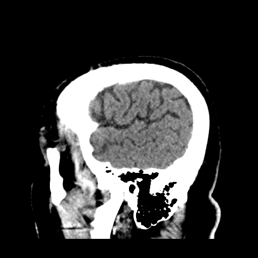 Atypical meningioma (WHO grade II) with brain invasion (Radiopaedia 57767-64728 Sagittal C+ 45).png