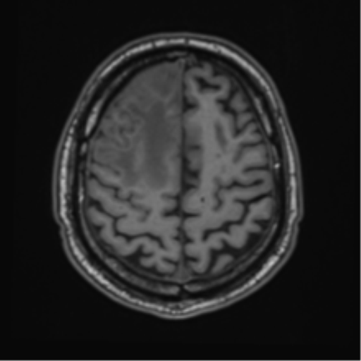 File:Atypical meningioma (WHO grade II) with brain invasion (Radiopaedia 57767-64729 Axial T1 41).png