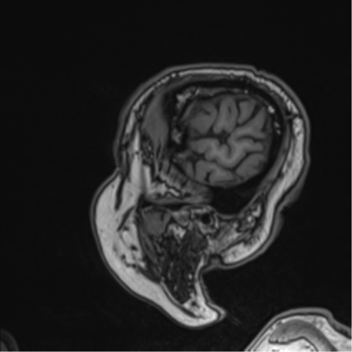 Atypical meningioma (WHO grade II) with brain invasion (Radiopaedia 57767-64729 Sagittal T1 58).png
