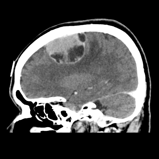 Atypical meningioma (WHO grade II) with osseous invasion (Radiopaedia 53654-59715 G 19).png