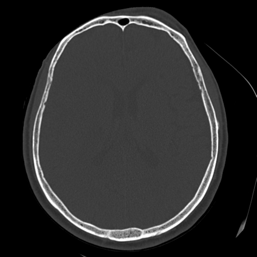 Atypical meningioma with skull invasion (Radiopaedia 34357-35649 Axial bone window 47).png