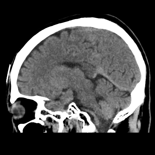 Atypical meningioma with skull invasion (Radiopaedia 34357-35649 E 32).png
