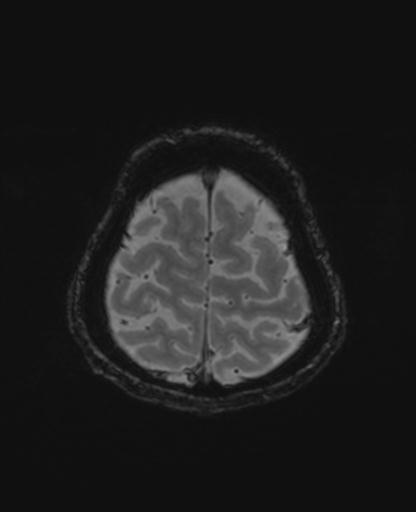 Autoimmune limbic encephalitis (Radiopaedia 30363-31005 SWI - magnitude 71).jpg