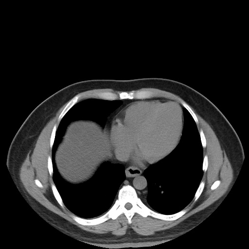 Autosomal dominant polycystic kidney disease (Radiopaedia 50259-55612 Axial non-contrast 10).jpg