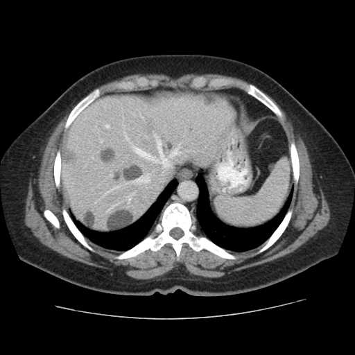 Autosomal dominant polycystic kidney disease with hepatic involvement (Radiopaedia 32693-33662 B 10).jpg