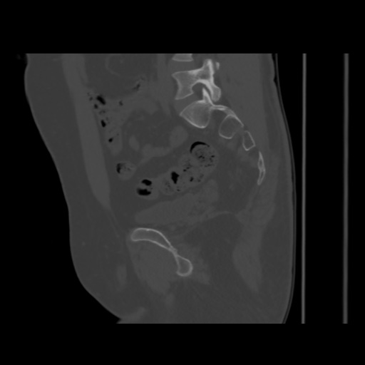 File:Avascular necrosis of the hip (Radiopaedia 61503-69467 B 26).jpg