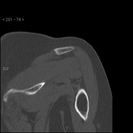Avascular necrosis of the shoulder - Cruess stage I (Radiopaedia 77674-89887 Coronal bone window 73).jpg