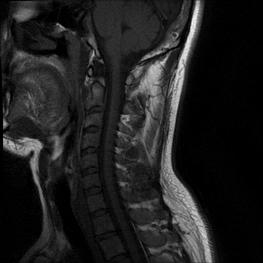 File:Axis fracture - MRI (Radiopaedia 71925-82375 Sagittal T1 4).jpg
