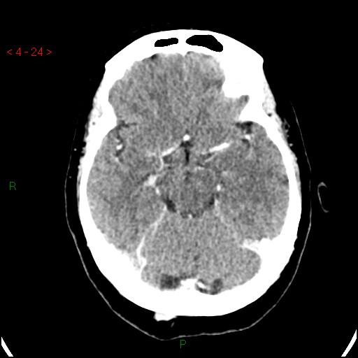 Azygos anterior cerebral artery (Radiopaedia 51987-57833 A 24).jpg