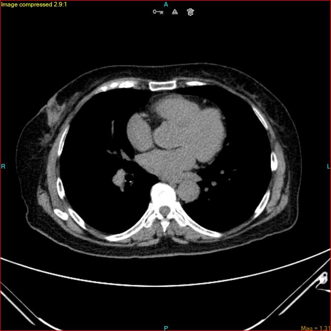 Azygos vein aneurysm (Radiopaedia 77824-90130 A 36).jpg
