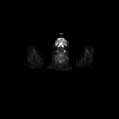 B-cell lymphoma of the mesentery (Radiopaedia 65743-74868 18F-FDG PET-CT 250).jpg