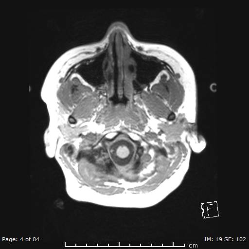 Balo concentric sclerosis (Radiopaedia 61637-69636 Axial T1 4).jpg
