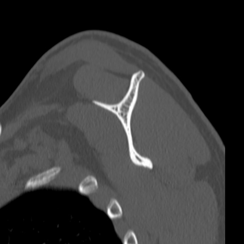 Bankart lesion (Radiopaedia 57256-64185 Sagittal bone window 42).jpg