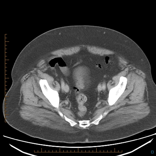 File:Bariatric balloon causing gastric outlet obstruction (Radiopaedia 54449-60672 A 36).jpg
