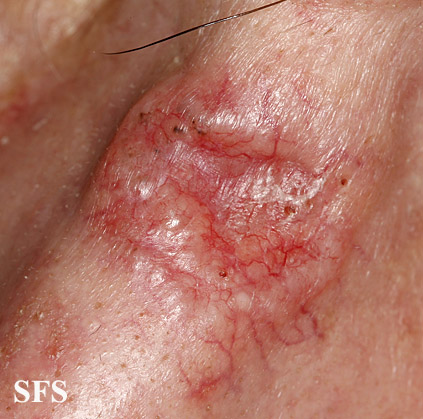 Basal Cell Carcinoma (Dermatology Atlas 218).jpg