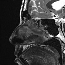 File:Basal cell carcinoma - nasal region (Radiopaedia 70292-80365 Sagittal T2 10).jpg