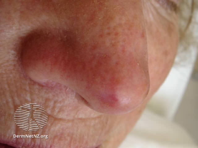 File:Basal cell carcinoma affecting the nose (DermNet NZ lesions-bcc-nose-0802).jpg